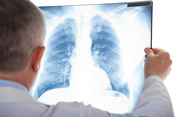 LuCaS - Lung Cancer Screening
